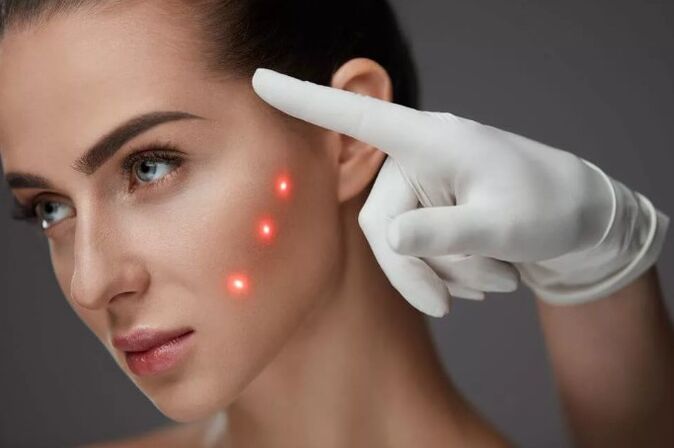Laser ҷавон шудани пӯст